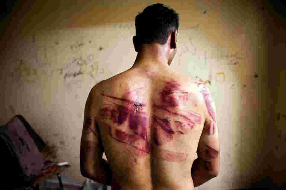 A Syrian civilian shows marks of torture after his release from regime forces in the Bustan Pasha neighborhood of Aleppo, Aug. 23.