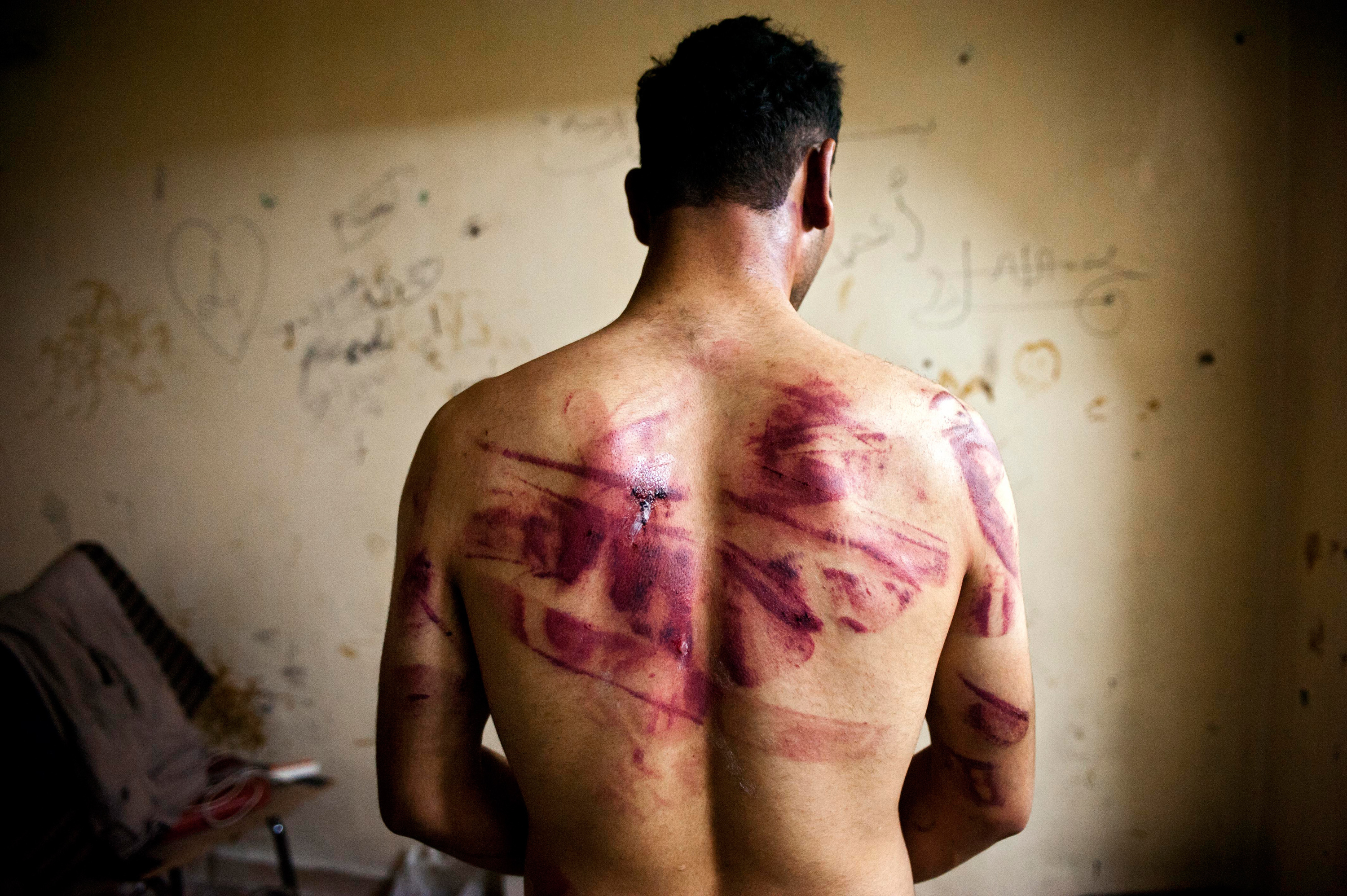A Syrian civilian shows marks of torture after his release from regime forces in the Bustan Pasha neighborhood of Aleppo, Aug. 23.