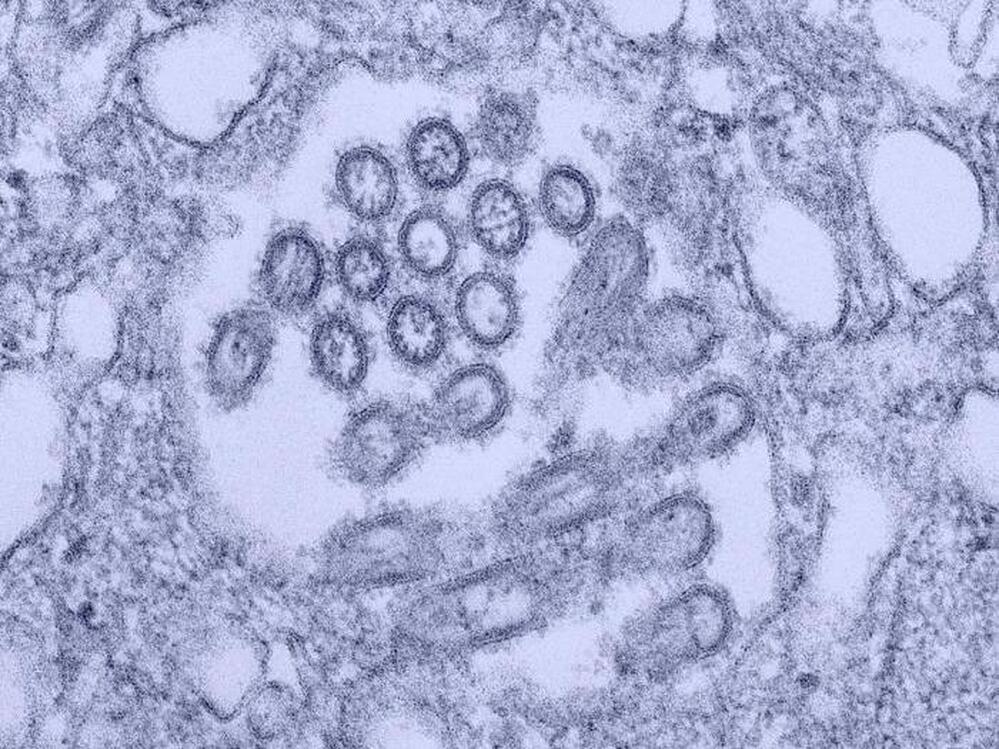 H1N1 virus virons appear in a tissue sample.