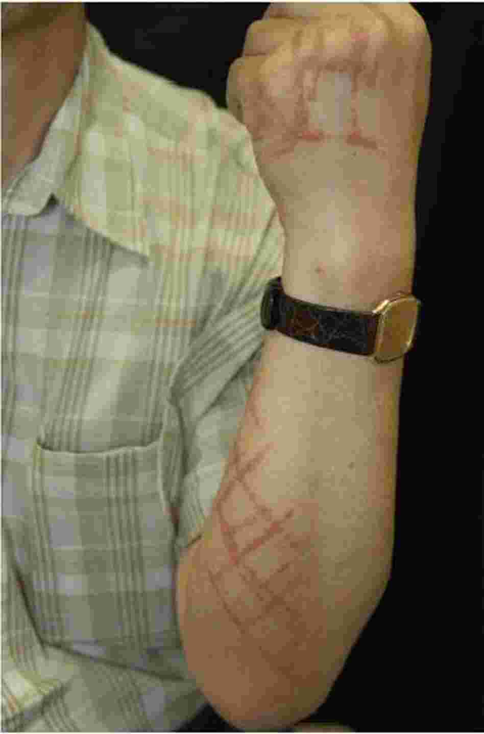 Urushiol, the chemical in poison ivy, is also harvested from the Japanese lacquer tree to coat lacquerware. Here, a rash caused by lacquerware that likely was not properly cured. Urushiol, the chemical in poison ivy, is also harvested from the Japanese lacquer tree to coat lacquerware. Here, a rash caused by lacquerware that likely was not properly cured.