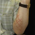 Urushiol, the chemical in poison ivy, is also harvested from the Japanese lacquer tree to coat lacquerware. Here, a rash caused by lacquerware that likely was not properly cured. Urushiol, the chemical in poison ivy, is also harvested from the Japanese lacquer tree to coat lacquerware. Here, a rash caused by lacquerware that likely was not properly cured.