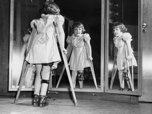 Many people infected with polio don't show any symptoms. Some become temporarily paralyzed; for others, it's permanent. In 1952, the polio epidemic reached a peak in the U.S.: almost 58,000 reported cases and more than 3,000 deaths.