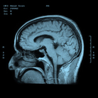 Brain scans are showing researchers why it's important to treat problems like depression in teens. Brain scans are showing researchers why it's important to treat problems like depression in teens.