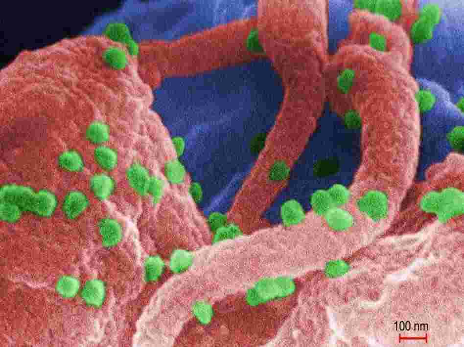 The HIV-1 virus cultivated with human lymphocytes.  The HIV-1 virus cultivated with human lymphocytes.