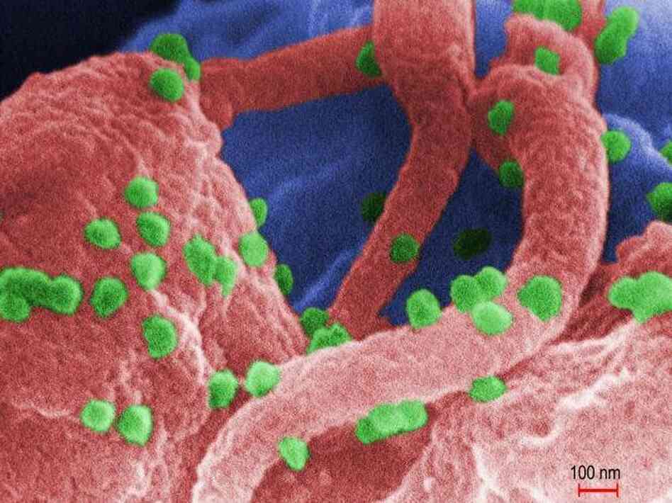The HIV-1 virus cultivated with human lymphocytes. 