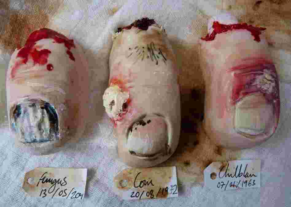 Toe nail cookies by Nevie Pie Cakes depict three unfortunate toe ailments: a fungal infection, corns, and chilblain. 