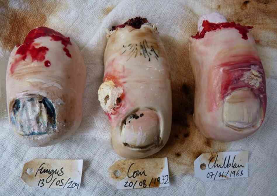 Toe nail cookies by Nevie Pie Cakes depict three unfortunate toe ailments: a fungal infection, corns, and chilblain. 
