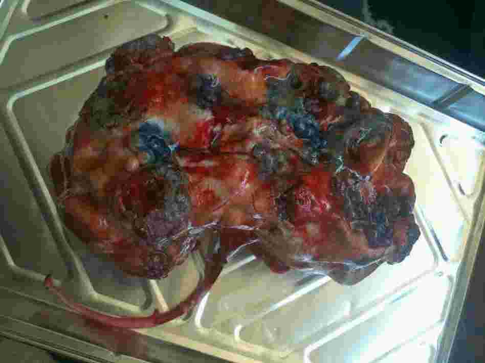 Kidney Cake: Cakes by Victoria baked this marshmallow red velvet cake to look like a post mortem, polycystic kidney.