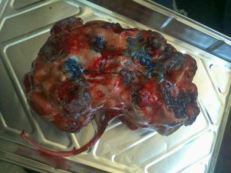 Kidney Cake: Cakes by Victoria baked this marshmallow red velvet cake to look like a post mortem, polycystic kidney.