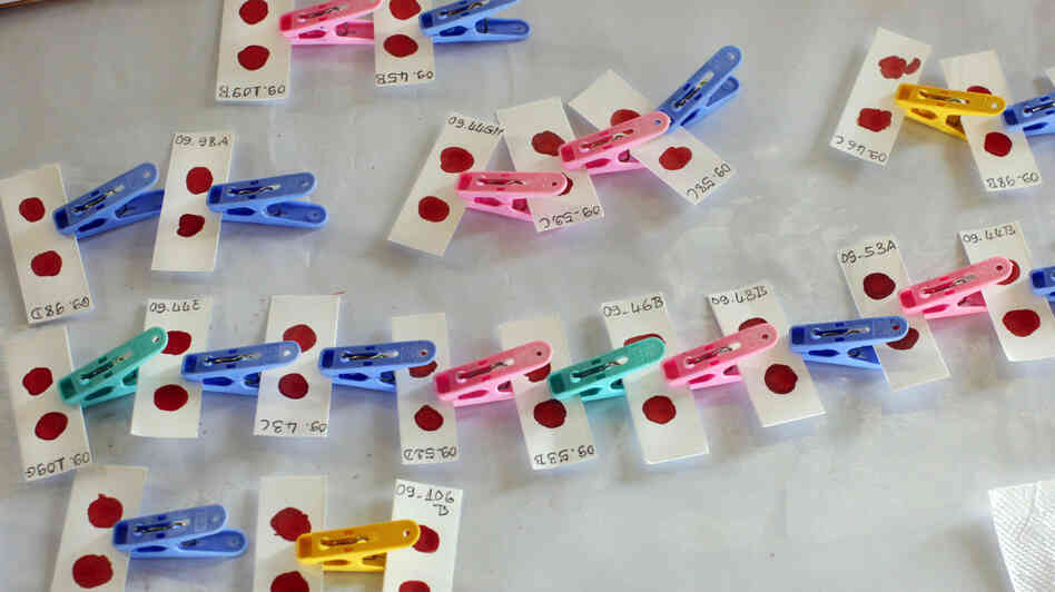 Blood samples dry during malaria screening. Public health workers call for more malaria testing in Africa to stop costly drugs from being handed out to kids with pneumonia.