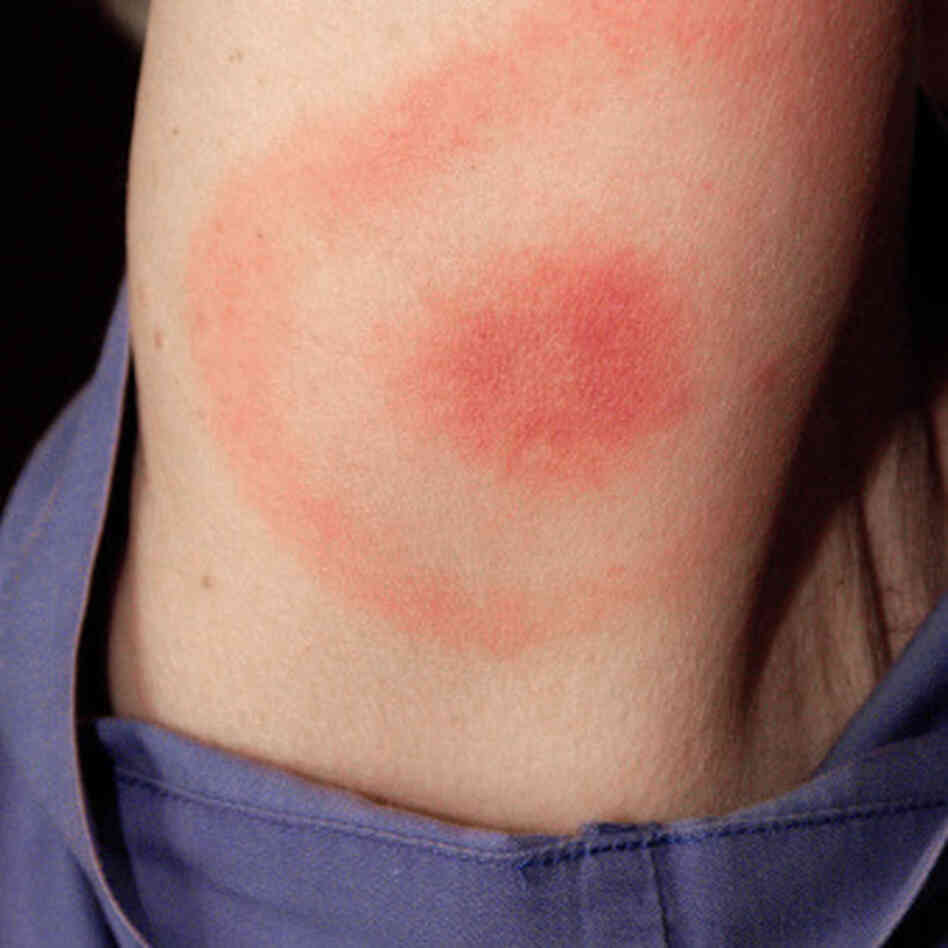 When a deer tick carrying the Lyme disease bacteria bites, the resulting rash can look like this bull's-eye. When a deer tick carrying the Lyme disease bacteria bites, the resulting rash can look like this bull's-eye.