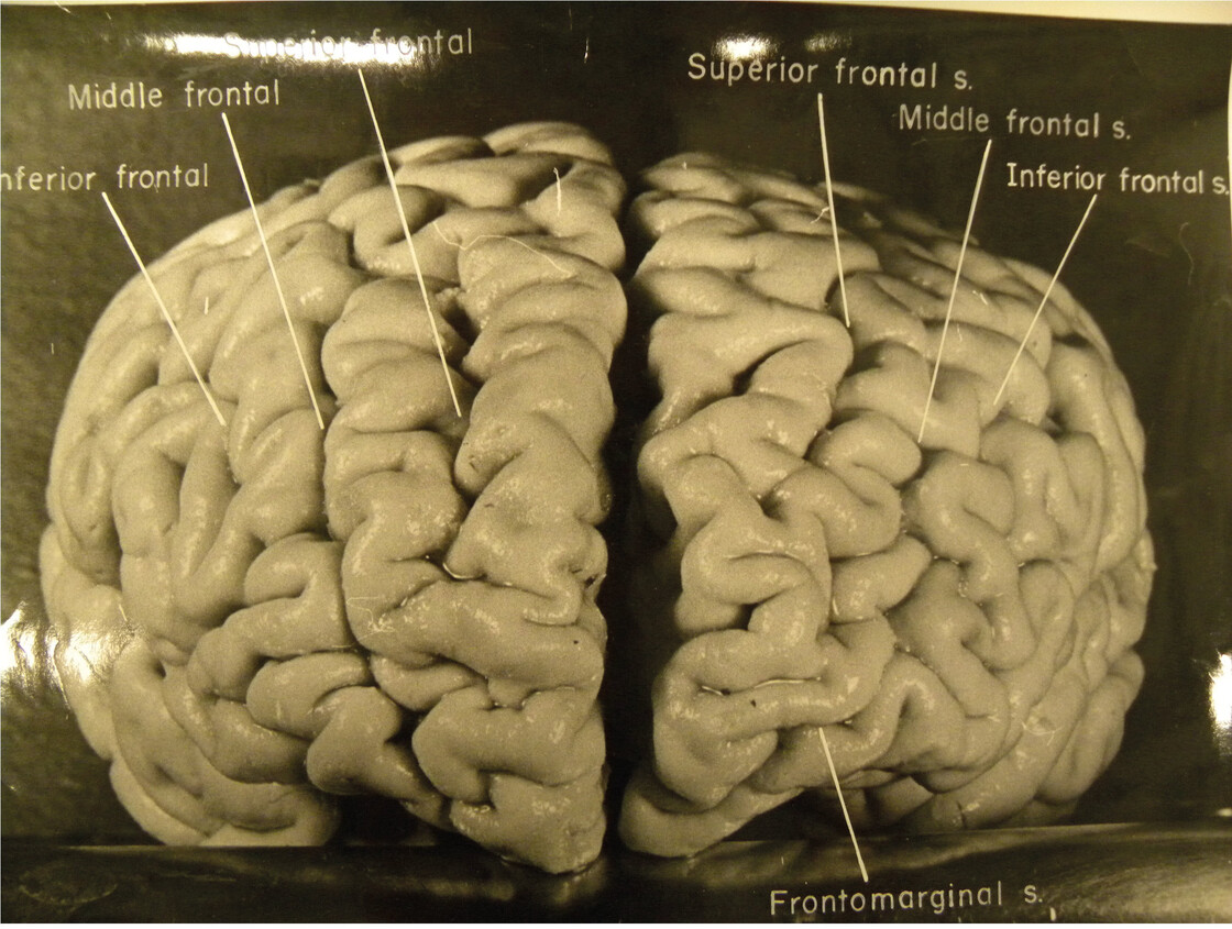 Pathologist Thomas Harvey took dozens of photos of Einstein's brain. This one shows that Einstein's prefrontal cortex (associated with higher cognition and memory) is unusually convoluted. On the right side of the brain there are four large ridges, where most people have only three.