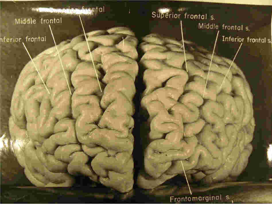 Pathologist Thomas Harvey took dozens of photos of Einstein's brain. This one shows that Einstein's prefrontal cortex (associated with higher cognition and memory) is unusually convoluted. On the right side of the brain there are four large ridges, where most people have only three.