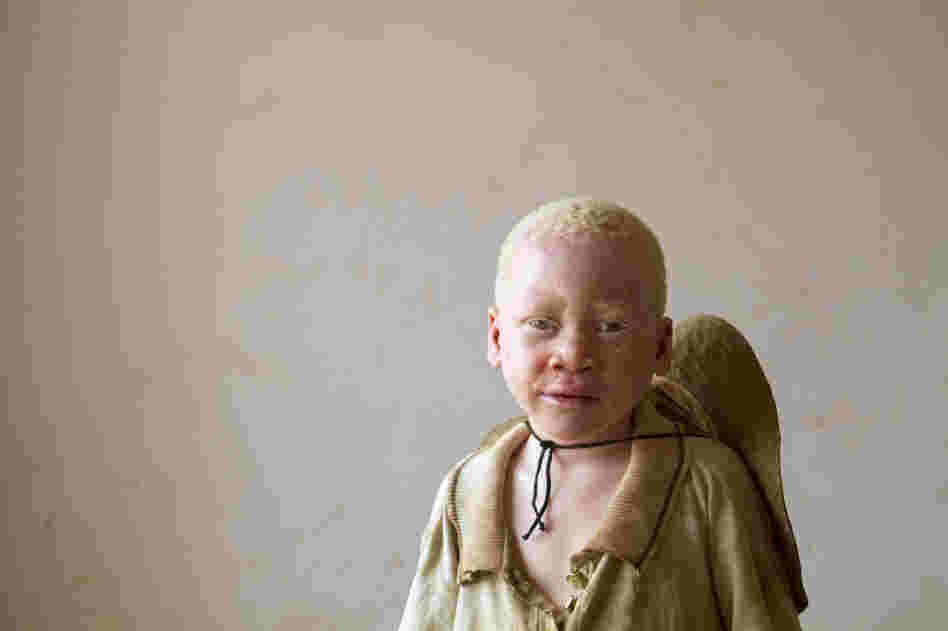 Musa, age unknown, was abandoned at the center. He is believed to be from the region bordering Burundi, where a black market in body parts of albinos is thriving.