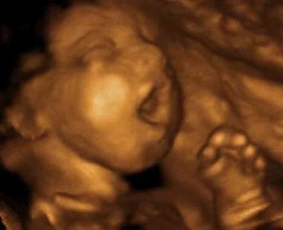 Could that be a yawn? An ultrasound scan catches an opened-mouth fetus. Could that be a yawn? An ultrasound scan catches an opened-mouth fetus.