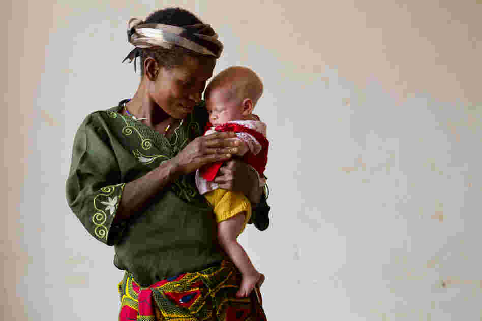 Helen Sekalima, 40, with her baby, Jessica, two months old, at the Kabanga Protectorate Center. Of Helen's nine children, three of them have albinism. "The people in the village said that the children are not normal people, that they are like devils," she said. Her husband was attacked protecting their oldest son from attackers, and now has limited mobility in his arm.