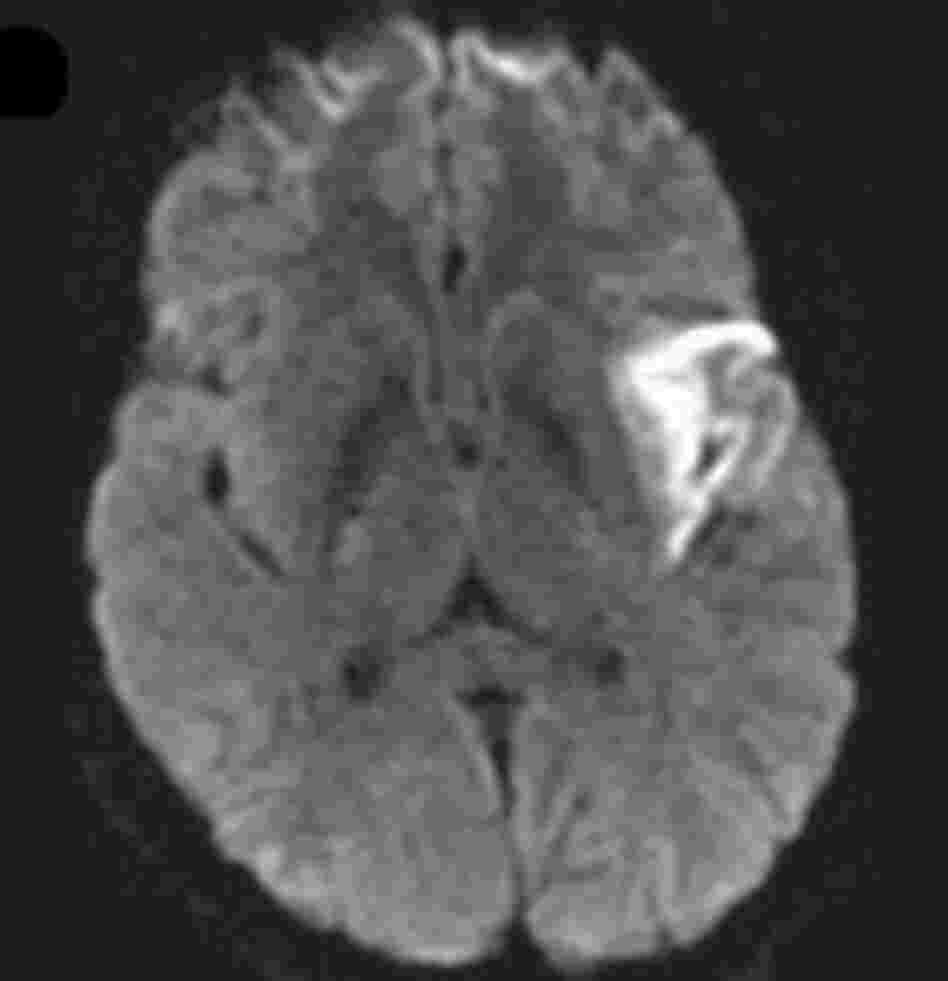 Another MRI of the woman's brain showed signs of a stroke in a region involved with language. Another MRI of the woman's brain showed signs of a stroke in a region involved with language.