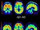 Brain scans using Amyvid dye to highlight beta-amyloid plaques in the brain. Clockwise from top left: a cognitively normal subject; an amyloid-positive patient with Alzheimer's disease; a patient with mild cognitive impairment who progressed to dementia during a study; and a patient with mild cognitive impairment. Brain scans using Amyvid dye to highlight beta-amyloid plaques in the brain. Clockwise from top left: a cognitively normal subject; an amyloid-positive patient with Alzheimer's disease; a patient with mild cognitive impairment who progressed to dementia during a study; and a patient with mild cognitive impairment.