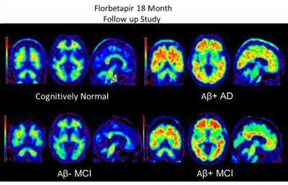 Brain scans using Amyvid dye to highlight beta-amyloid plaques in the brain. Clockwise from top left: a cognitively normal subject; an amyloid-positive patient with Alzheimer's disease; a patient with mild cognitive impairment who progressed to dementia during a study; and a patient with mild cognitive impairment. Brain scans using Amyvid dye to highlight beta-amyloid plaques in the brain. Clockwise from top left: a cognitively normal subject; an amyloid-positive patient with Alzheimer's disease; a patient with mild cognitive impairment who progressed to dementia during a study; and a patient with mild cognitive impairment.