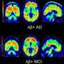 Brain scans using Amyvid dye to highlight beta-amyloid plaques in the brain. Clockwise from top left: a cognitively normal subject; an amyloid-positive patient with Alzheimer's disease; a patient with mild cognitive impairment who progressed to dementia during a study; and a patient with mild cognitive impairment. Brain scans using Amyvid dye to highlight beta-amyloid plaques in the brain. Clockwise from top left: a cognitively normal subject; an amyloid-positive patient with Alzheimer's disease; a patient with mild cognitive impairment who progressed to dementia during a study; and a patient with mild cognitive impairment.