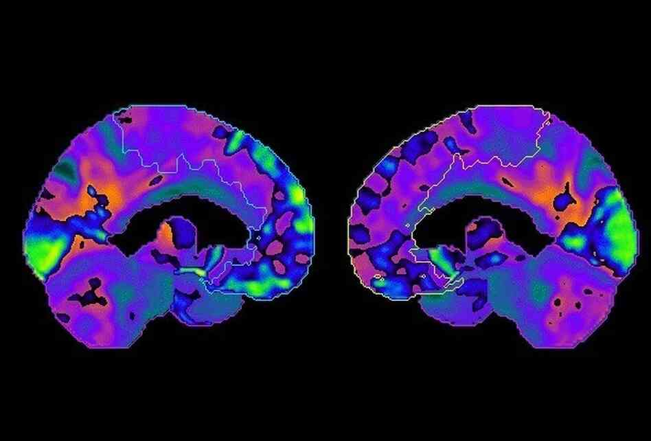 Dr. Jame Abraham used positron emission tomography, or PET