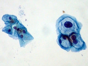 Cells gathered during a Pap test. Those on the left are normal, and those on the right are infected with human papillomavirus.