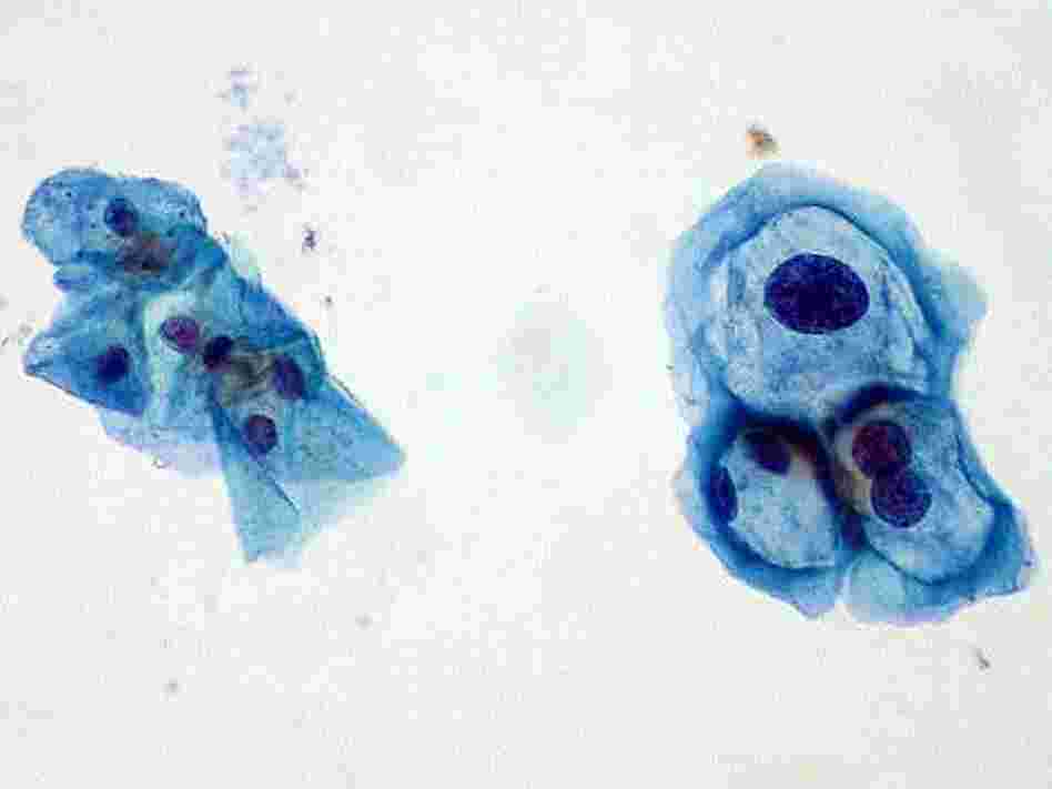 Cells gathered during a Pap test. Those on the left are normal, and those on the right are infected with human papillomavirus.
