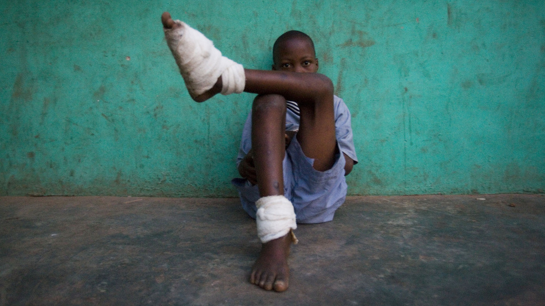 A boy with multiple Guinea worms sits outside a containment center in northern Ghana, February 2007.