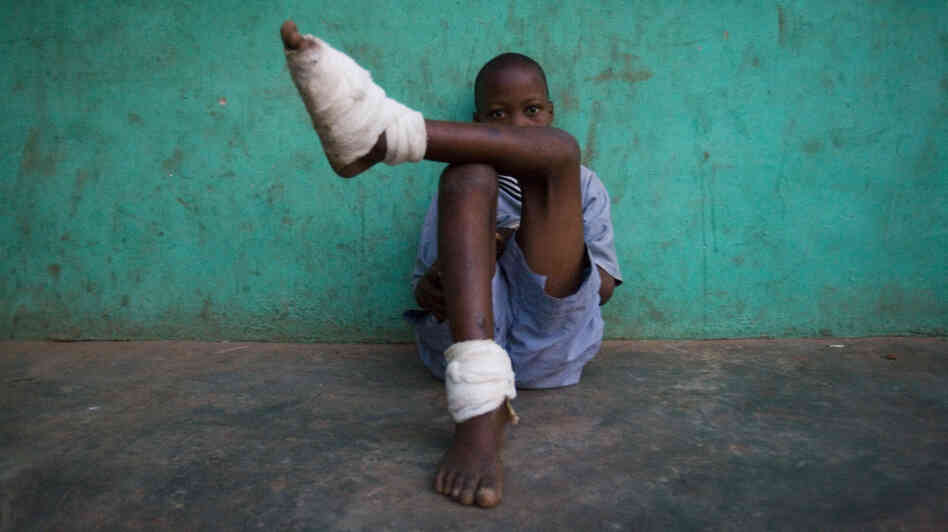 A boy with multiple Guinea worms sits outside a containment center in northern Ghana, February 2007.