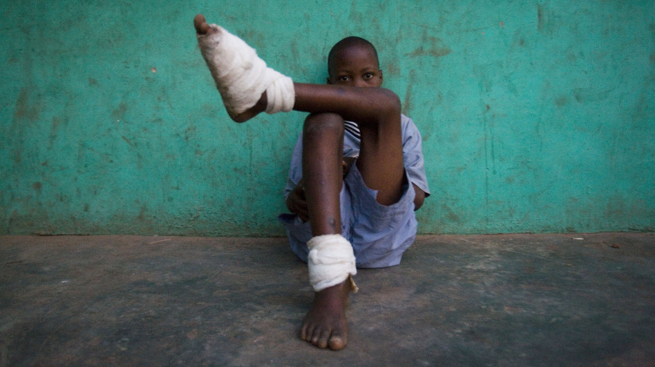 A boy with multiple Guinea worms sits outside a containment center in northern Ghana, February 2007.