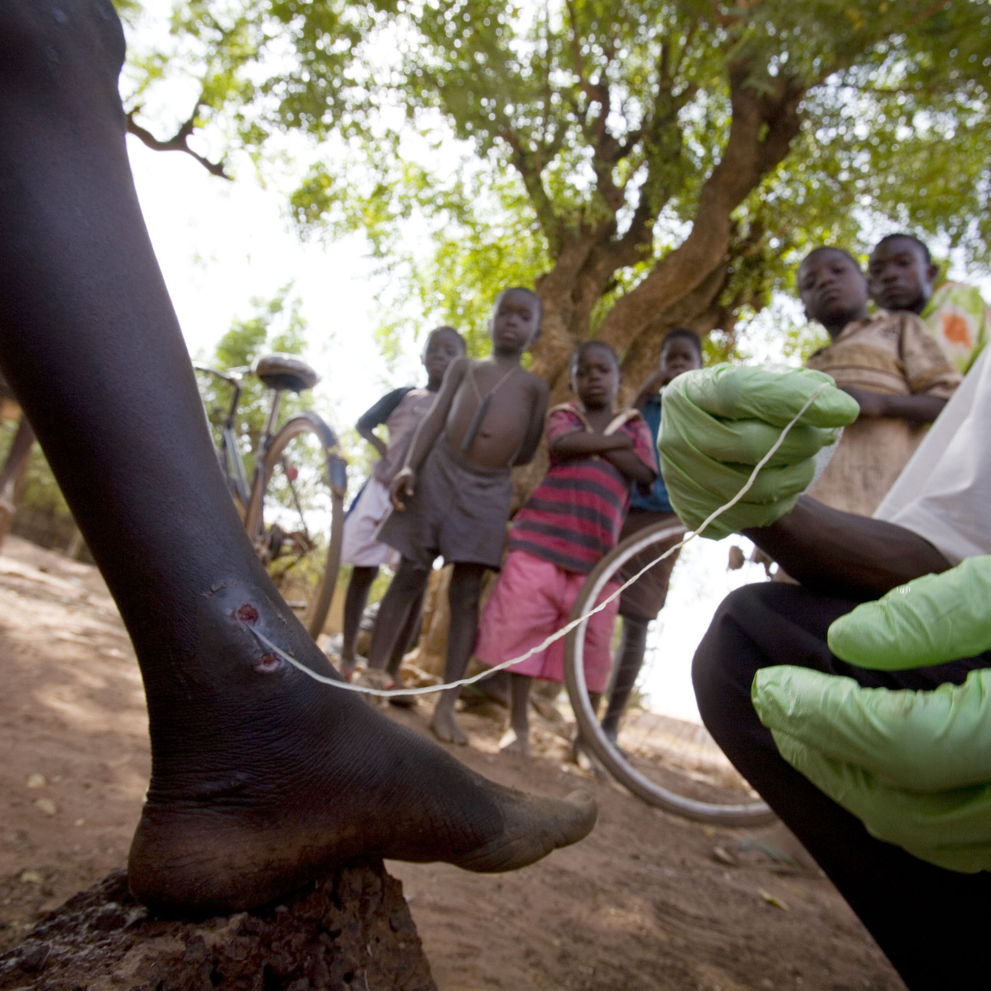 A medical worker extracts a Guinea worm from a child's leg in northern Ghana, February 2007.