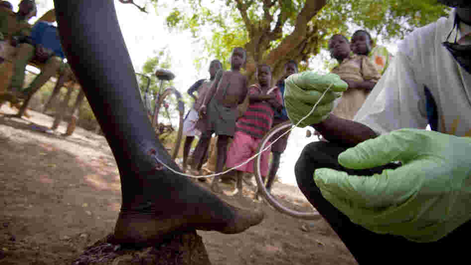 A medical worker extracts a Guinea worm from a child's leg in northern Ghana, February 2007.