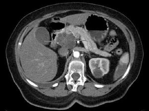 A CT scan showing an adenocarcinoma of the pancreatic head.
