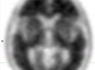 The loss of contrast between gray and white matter in this brain scan indicates a high uptake of Amyvid and the presence of amyloid plaques. The loss of contrast between gray and white matter in this brain scan indicates a high uptake of Amyvid and the presence of amyloid plaques.