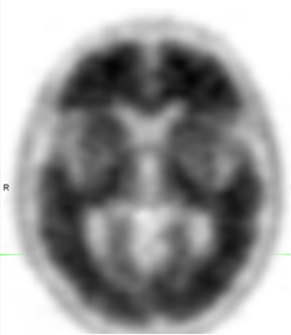 The loss of contrast between gray and white matter in this brain scan indicates a high uptake of Amyvid and the presence of amyloid plaques.