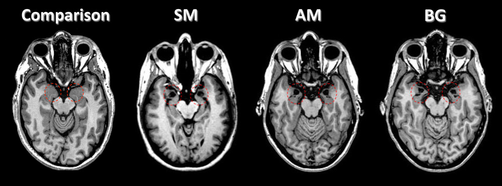 In these brain scans, amygdala damage can be seen in three patients (known as SM, AM and BG) with Urbach-Wiethe disease. See the dark spots within the areas circled in red. A healthy person is shown (left) for comparison.