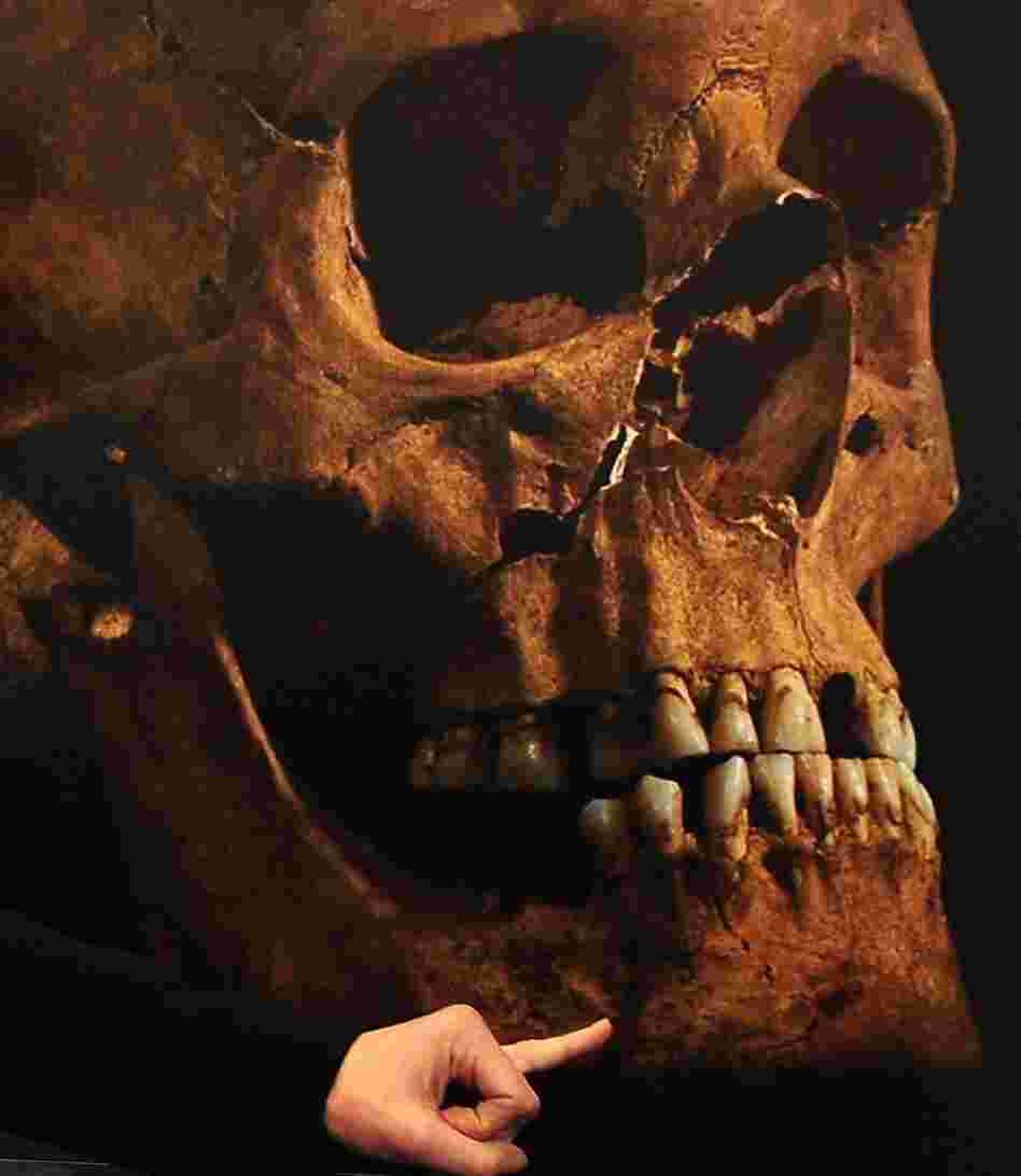 An enlarged image of the skull identified as that of King Richard III. Jo Appleby, a lecturer in human bioarchaeology at the University of Leicester, is pointing to a detail. An enlarged image of the skull identified as that of King Richard III. Jo Appleby, a lecturer in human bioarchaeology at the University of Leicester, is pointing to a detail.