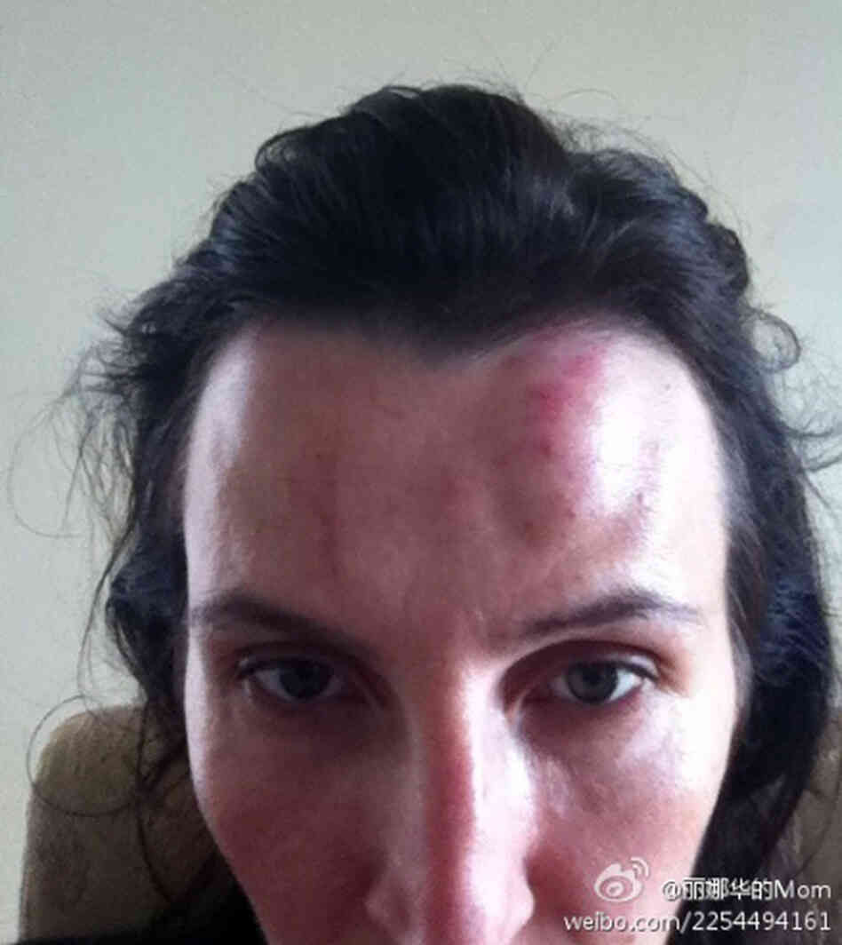 This was one of the photos American Kim Lee posted online after her Chinese husband, a famous English teacher, beat her. Her decision to go public marks a milestone in the fight against domestic abuse in China. This was one of the photos American Kim Lee posted online after her Chinese husband, a famous English teacher, beat her. Her decision to go public marks a milestone in the fight against domestic abuse in China.