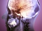An angiogram of a 48-year- old patient after treatment for a stroke. A blockage was targeted with clot-busting drugs using a catheter. An angiogram of a 48-year- old patient after treatment for a stroke. A blockage was targeted with clot-busting drugs using a catheter.