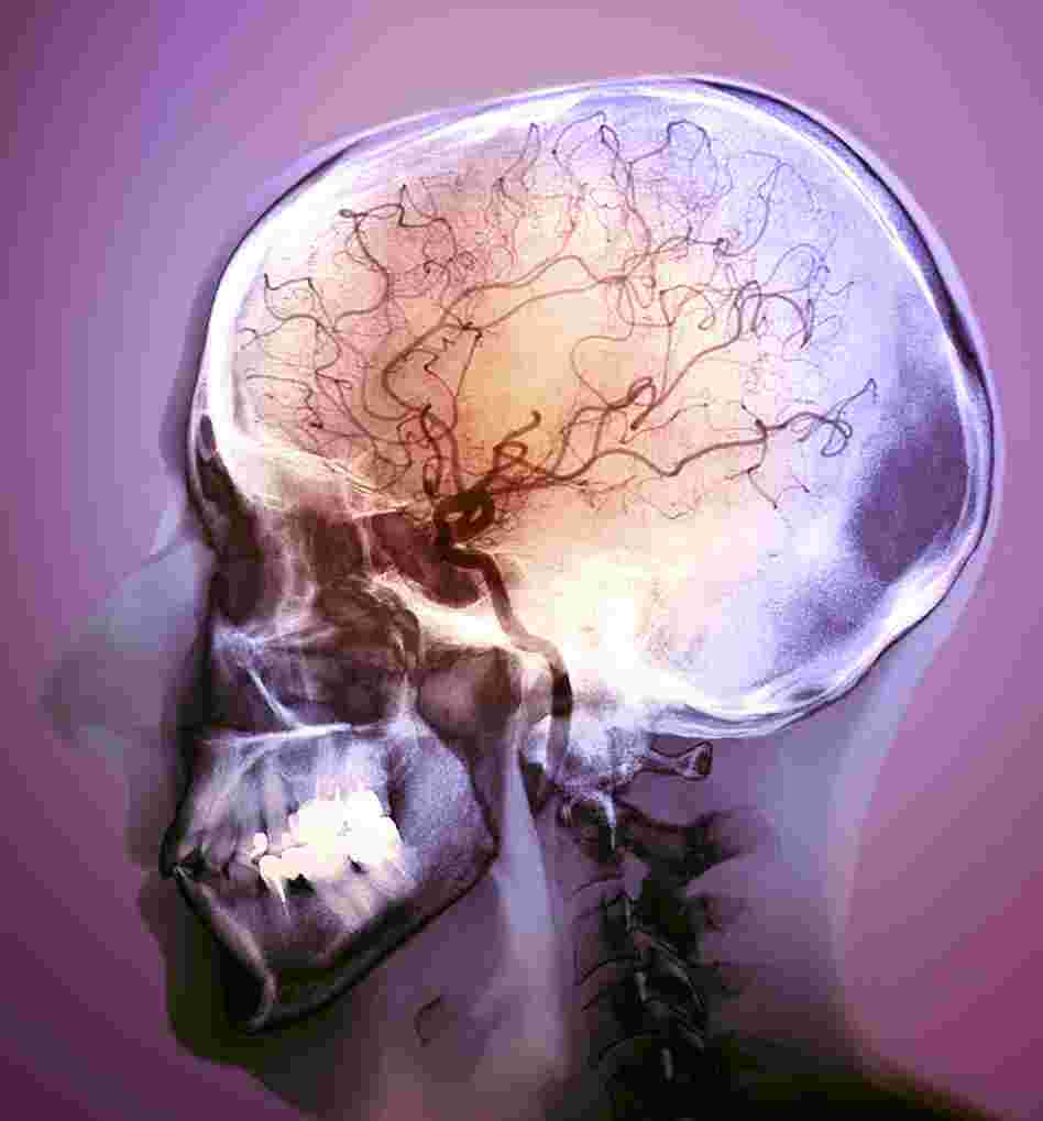 An angiogram of a 48-year- old patient after treatment for a stroke. A blockage was targeted with clot-busting drugs using a catheter.