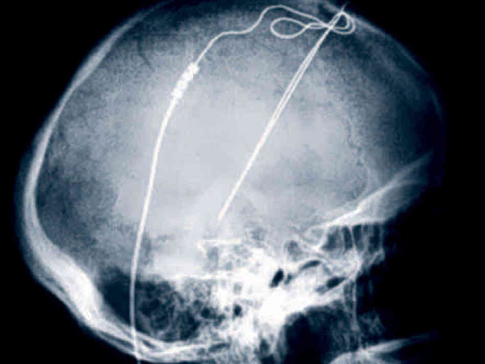An X-ray of electrodes implanted in the brain of a Parkinson's patient at the Cleveland Clinic. Now deep brain stimulation like this is being tried experimentally in a few patients with chronic, serious anorexia.