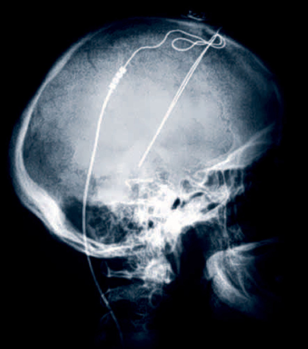 An X-ray of electrodes implanted in the brain of a Parkinson's patient at the Cleveland Clinic. Now deep brain stimulation like this is being tried experimentally in a few patients with chronic, serious anorexia.