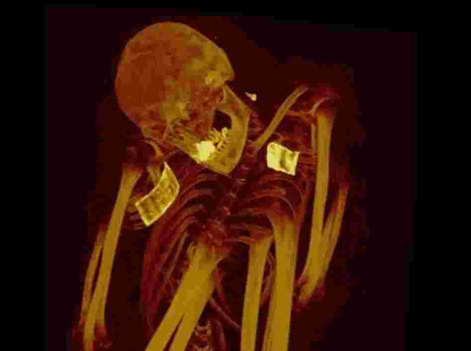 The CT scans of a Peruvian mummy from about 200-900 B.C. showed calcification in the aorta and iliac arteries. The CT scans of a Peruvian mummy from about 200-900 B.C. showed calcification in the aorta and iliac arteries.