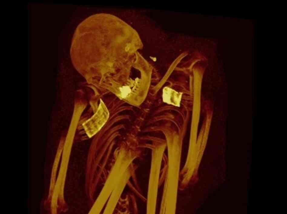 The CT scans of a Peruvian mummy from about 200-900 B.C. showed calcification in the aorta and iliac arteries. The CT scans of a Peruvian mummy from about 200-900 B.C. showed calcification in the aorta and iliac arteries.