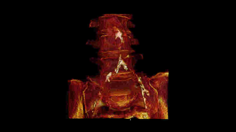 A 3-D reconstruction of Mummy 38's CT scans shows calcification in her aorta and iliac arteries.