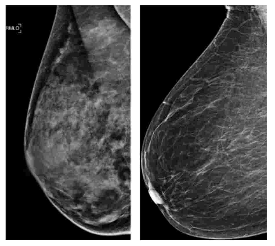 These two photos shows an extremely dense breast (left) and a least dense breast. A new study indicates that women under 50 with dense breast tissue can benefit from mammograms. These two photos shows an extremely dense breast (left) and a least dense breast. A new study indicates that women under 50 with dense breast tissue can benefit from mammograms.