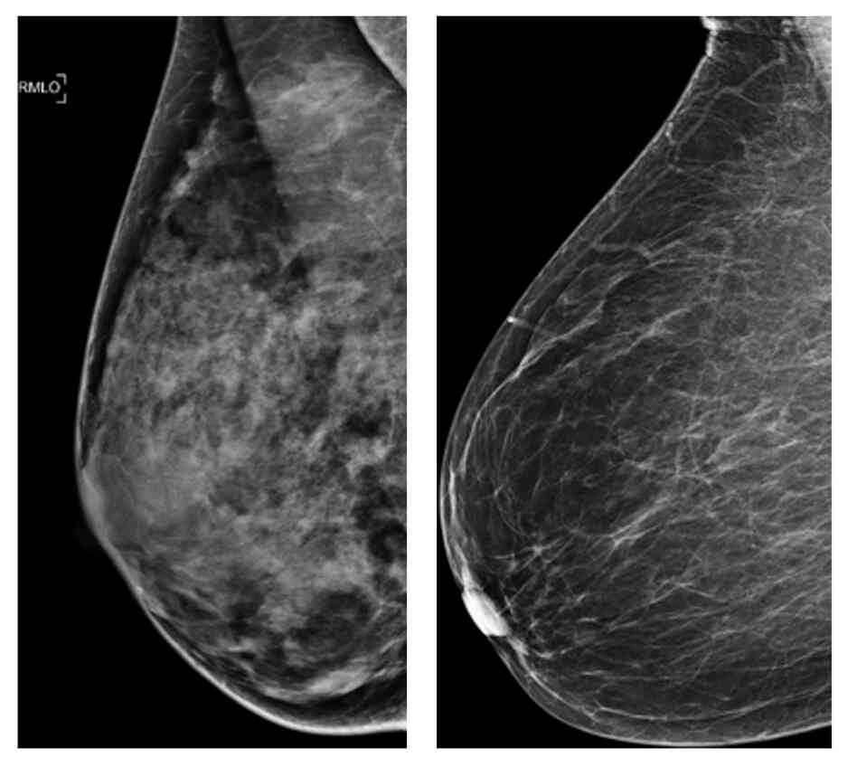 These two photos shows an extremely dense breast (left) and a least dense breast. A new study indicates that women under 50 with dense breast tissue can benefit from mammograms. These two photos shows an extremely dense breast (left) and a least dense breast. A new study indicates that women under 50 with dense breast tissue can benefit from mammograms.