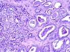 A microscopic image of prostate cancer. Researchers have found new genetic markers that flag a person's susceptibility to the disease, as well as breast and ovarian cancer. A microscopic image of prostate cancer. Researchers have found new genetic markers that flag a person's susceptibility to the disease, as well as breast and ovarian cancer.