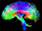 A colored 3-D MRI scan of the brain's white matter pathways traces connections between cells in the cerebrum and the brainstem. A colored 3-D MRI scan of the brain's white matter pathways traces connections between cells in the cerebrum and the brainstem.
