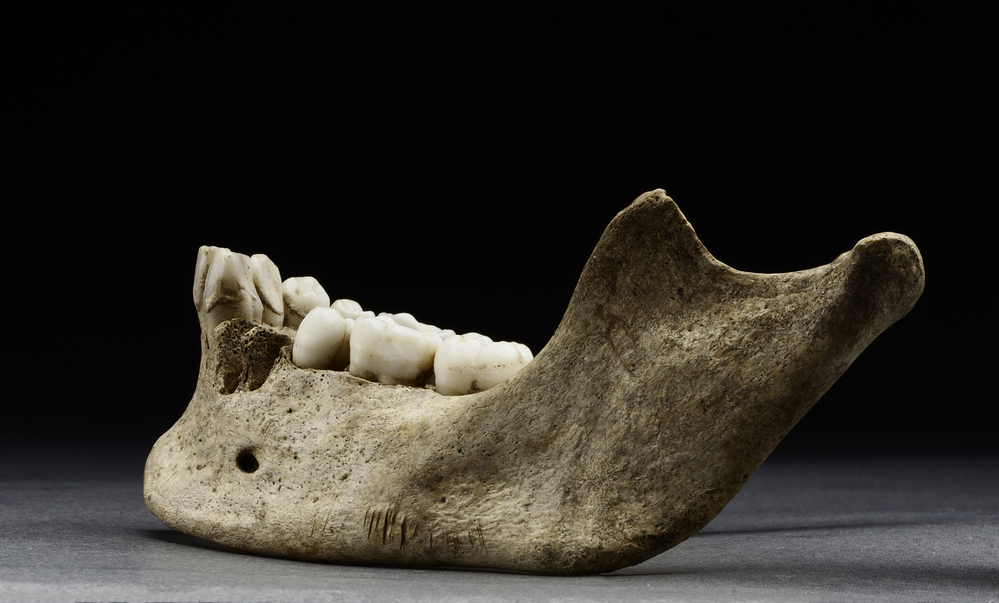 Markings on the lower side of the jaw look like they were sawed with a sharp object, says forensic anthropologist Douglas Owsley.